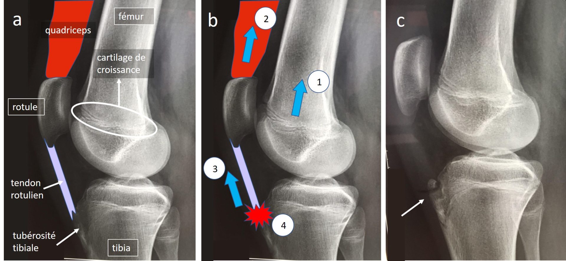 Le Syndrome D'osgood-schlatter - Orthopedie-pediatrique.com