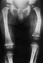 radiographie d'un fémur congénital responsable d'une inégalité de longueur des jambes