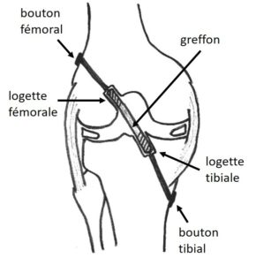 schéma montrant le principe d'une des techniques de ligamentoplastie du ligament croisé antérieur chez l'enfant: le DT4