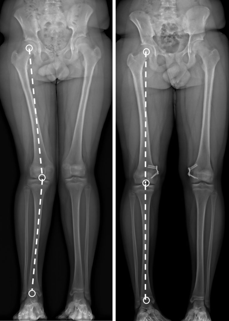 radiographie montrant l'effet d'un système de blocage de croissance (ou épiphysiodèse) asymétrique pour traiter une déviation de la forme des jambes type genu valgum