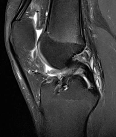 vidéo montrant le résultat à l'IRM d'une ligamentoplastie du ligament croisé antérieur type DT4