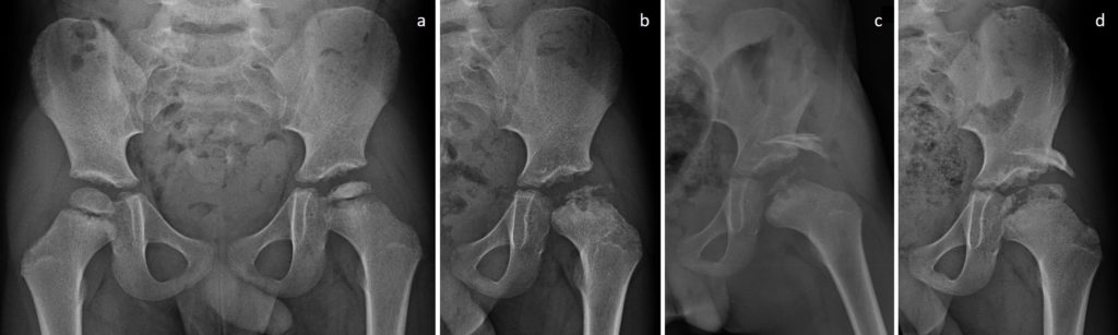 radiographie d'une ostéochondrite de hanche. Le déplacement de la tête a fait réaliser une chirurgie de type butée de hanche