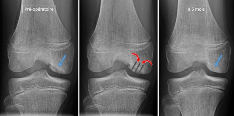 radiographies montrant une ostéochondrite du genou, le principe de chirurgie par perforation et sa guérison