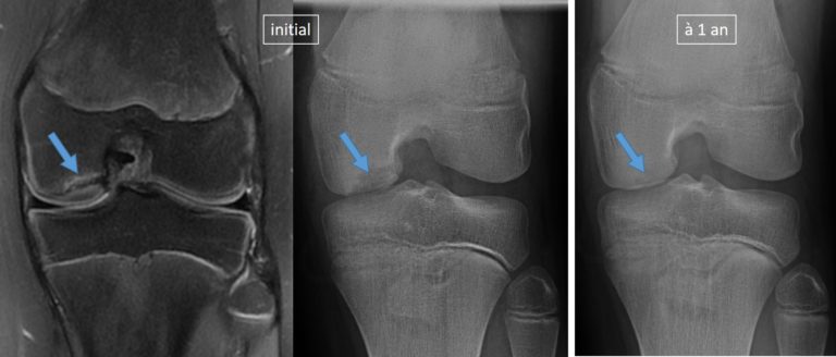 IRM et radiographies montrant une ostéochondrite du genou et sa guérison