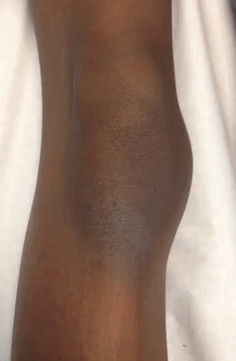 vidéo montrant une luxation de la rotule lors de la flexion du genou