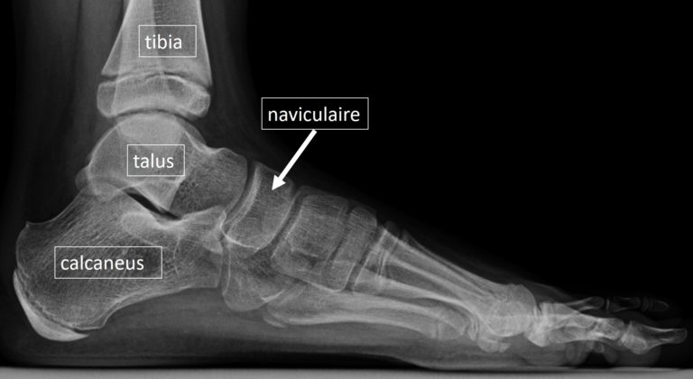 Les Synostoses ORTHOPEDIE PEDIATRIQUE COM