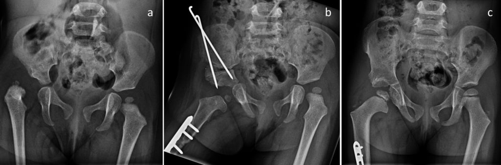 radiographies avant et après chirurgie pour luxation congénitale de hanche