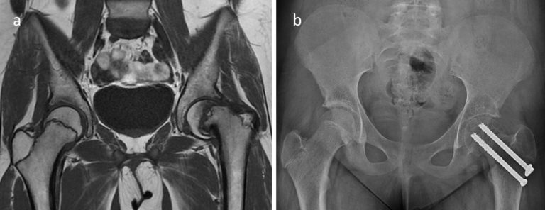 IRM et radiographie d'une épiphysiolyse à grand déplacement ayant nécessité une chirurgie de repositionnement de la tête du fémur