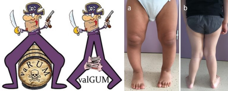 dessins et photographies expliquant le genu varum et le genu valgum