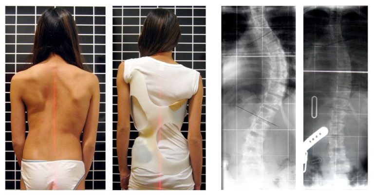 photo de corset pour traiter une scoliose et radiographie montrant son efficacité sur la courbure de la colonne vertébrale