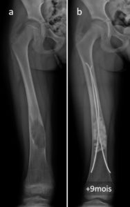 radiographies montrant un kyste osseux essentiel ayant nécessité une chirurgie