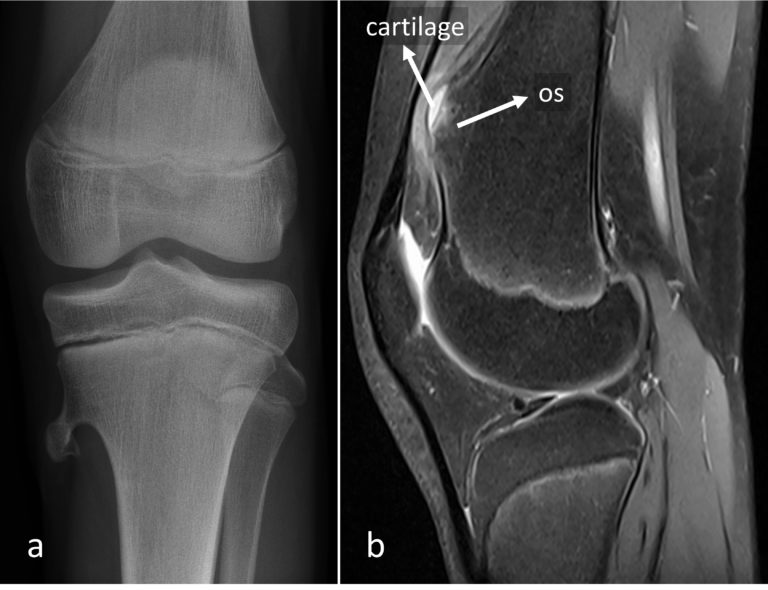 radiographie et IRM d'une exostose montrant la partie osseuse et cartilagineuse