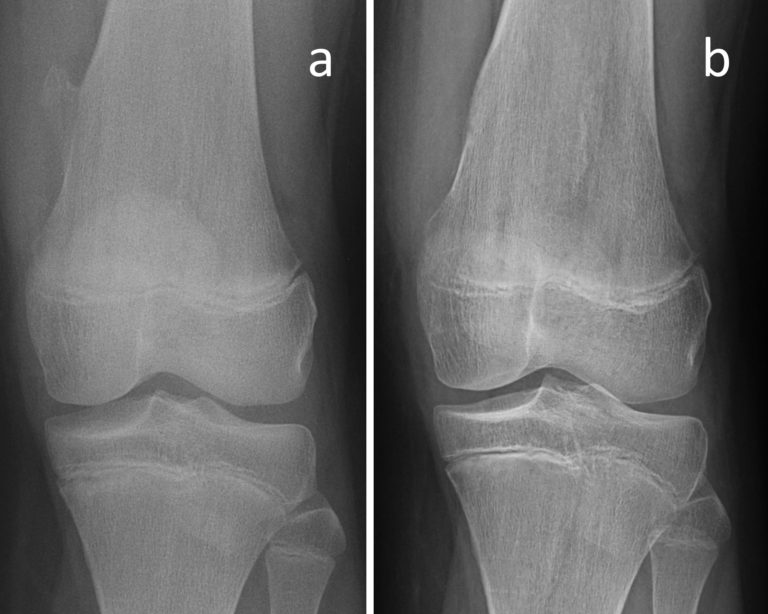 radiographies montrant une exostose avant et après chirurgie