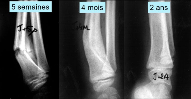 radiographies montrant le redressement du déplacement d'une fracture ne touchant pas de cartilage de croissance