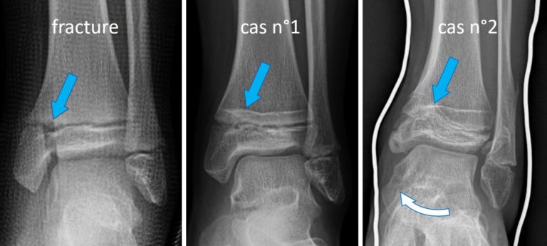 radiographie montrant un trouble de croissance après une fracture touchant un cartilage de croissance