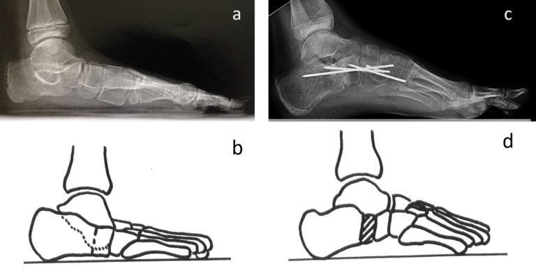schémas et radiographie montrant le principe de la technique d'allongement du calcaneum pour la correction du pied plat de l'enfant