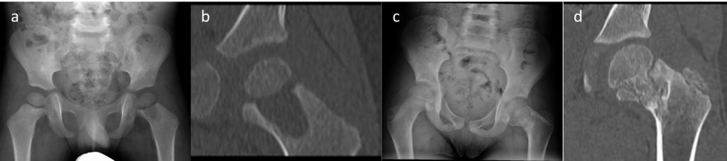 radiographies et scanner montrant une ostéomyélite touchant la zone de crissance du haut du fémur, responsable secondairement d'un trouble de croissance