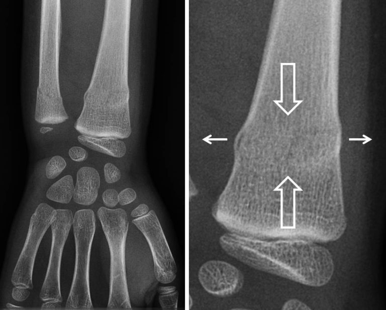 Fractures Ne Touchant Pas De Cartilage De Croissance Fractures Ne Touchant Pas De Cartilage De Croissance
