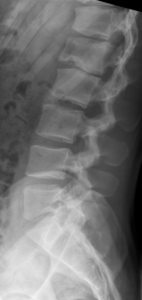 radiographie d'une maladie de scheuermann du rachis lombaire