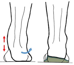 schéma d'un pied valgus et de l'effet correcteur d'une semelle avec un coin talonnier varisant