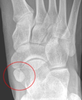 Radiographie Des Os Du Pied Membre Inf rieur Radiographie