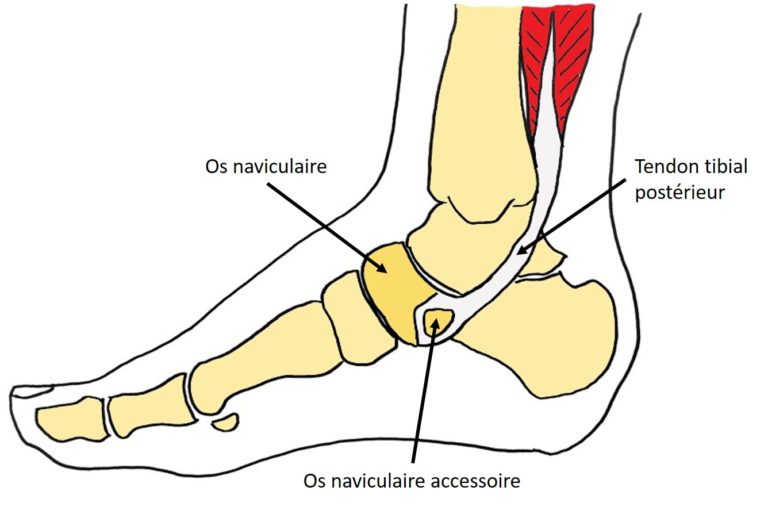 schéma du pied montrant un os naviculaire accessoire sur lequel s'attache le tendon du muscle tibial postérieur