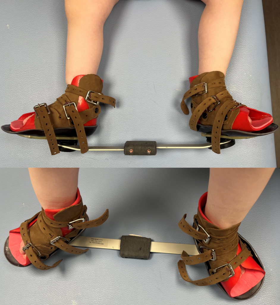 attelle de ponseti utilisée pour le maintien d'un pied bot varus équin traité selon la méthode de Ponseti